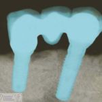 Neue Zähne auf Implantaten